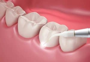 Laser Gum Treatment - Pain free solution for gum disease 