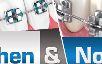 Orthodontic Treatment – Braces, Then and Now