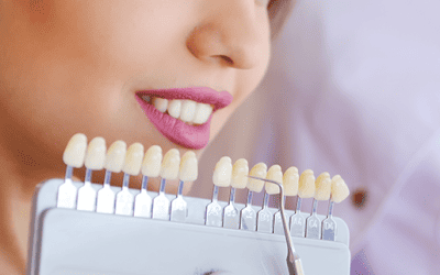 What You Need to Know About Veneers
