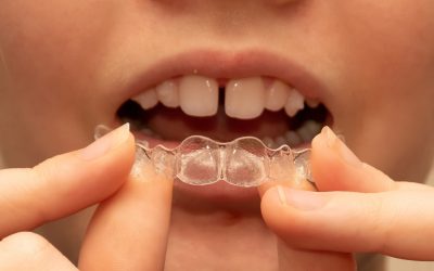 How Can Orthodontic Appliances Correct Gaps in Teeth?