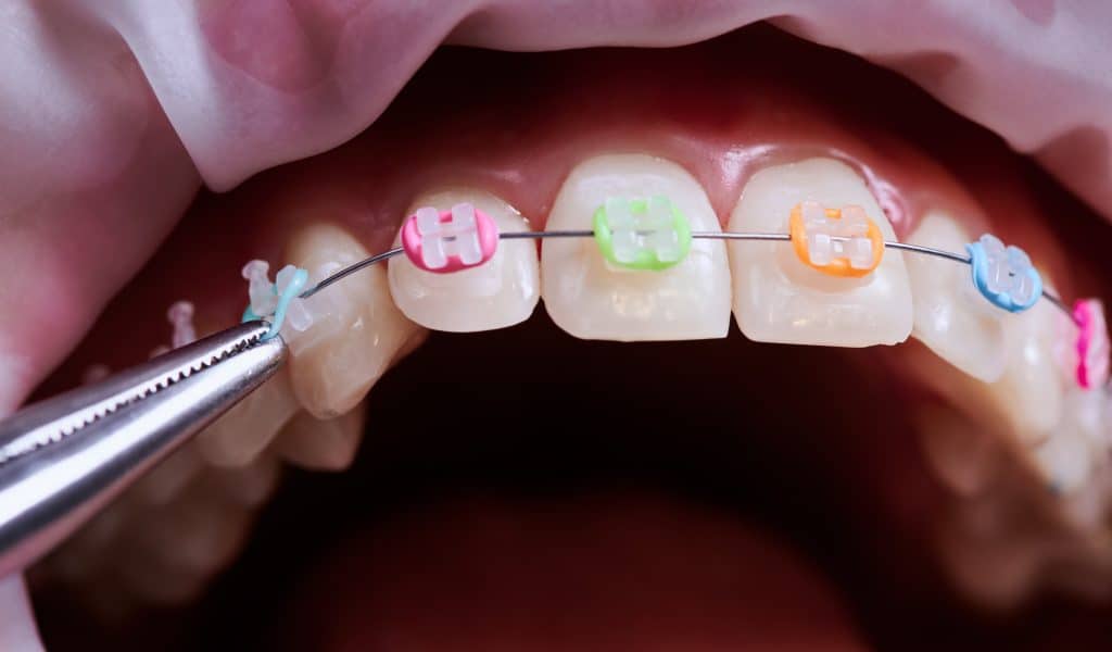 How Rubber Bands For Braces Help Align Your Teeth During Treatment
