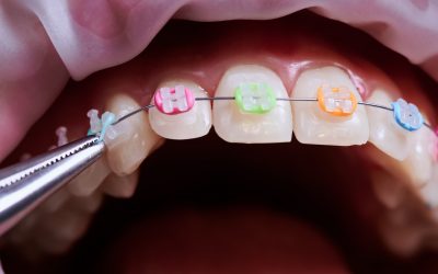 How Rubber Bands For Braces Help Align Your Teeth During Treatment?