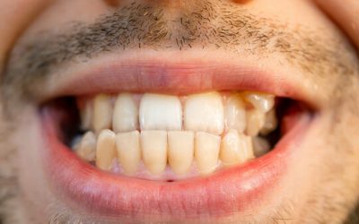 The Impact of Crossbite on Oral Health – What You Need to Know