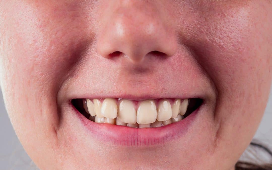 Overlapping Teeth