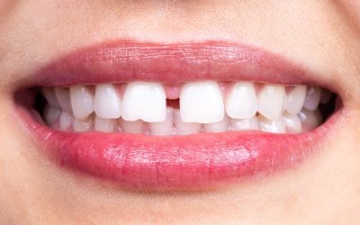 Seal the Deal: How Teeth Gap Filling Boosts Your Confidence