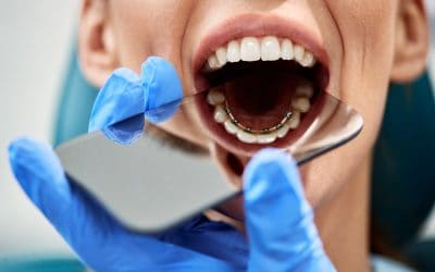 Can You Fix an Overbite with Lingual Braces?