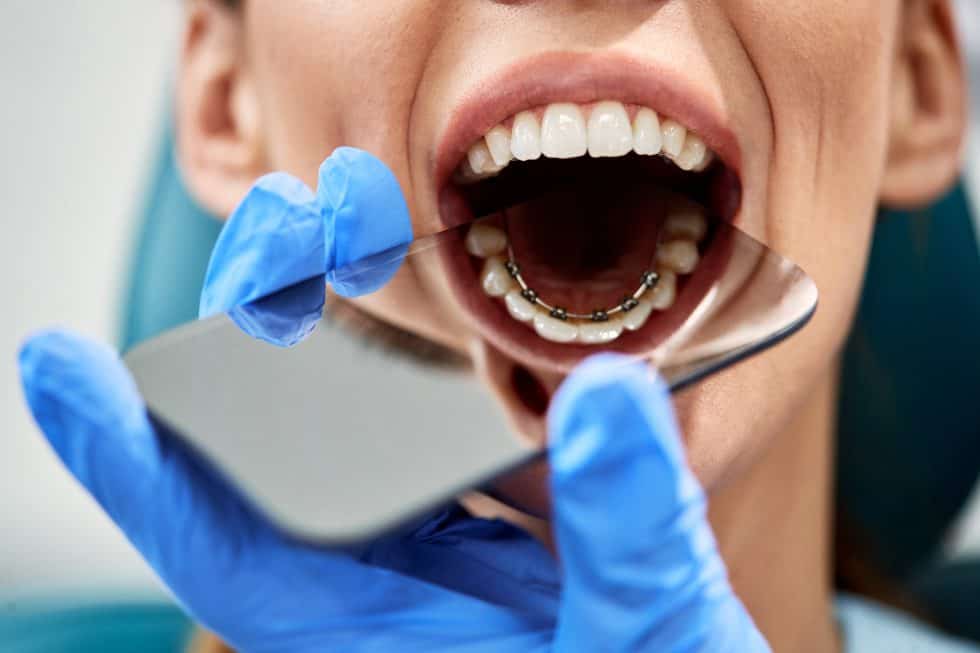 Can You Fix an Overbite with Lingual Braces? Dental Health Clinic