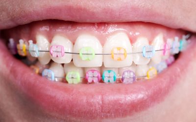 How do elastic rubber bands for braces work?