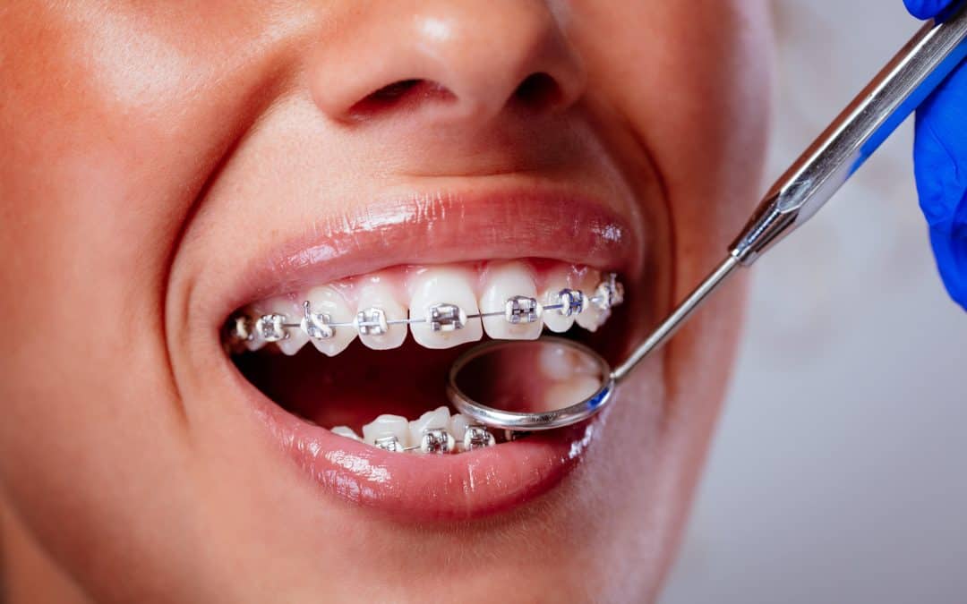 X on X: Metal Braces VS Clear Aligners #orthodontics #dental #dentistry  #Dentists #invisalign 🦷  / X