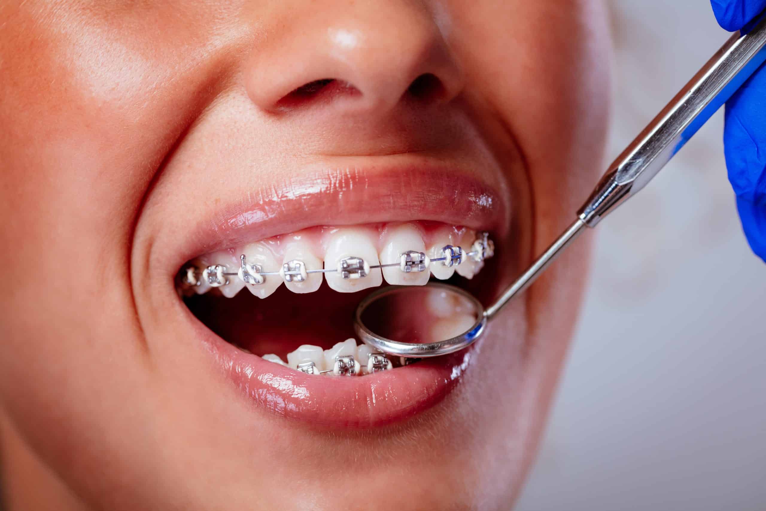Which Types of Braces Right for Me? And How It Working - Dental Health  Clinic