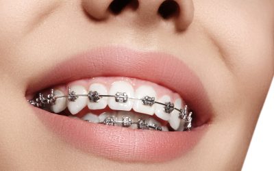 Overjet Teeth: A Comprehensive Guide to Causes and Treatment