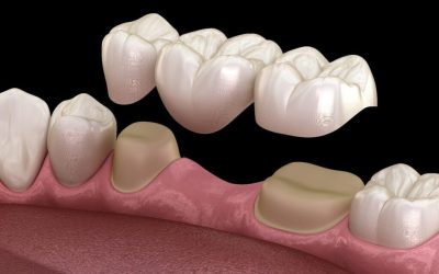 Why Choose a Removable Dental Bridge? Everything You Need to Know