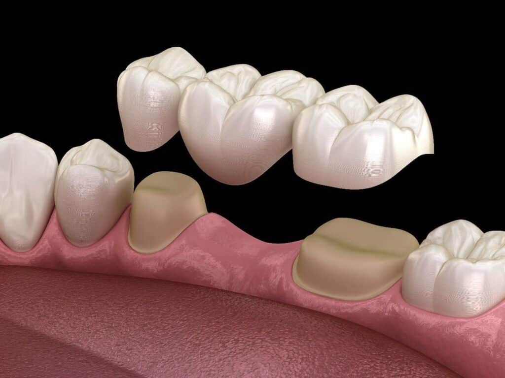 Removable dental bridge