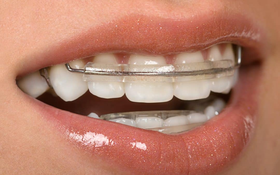 Teeth Retainer