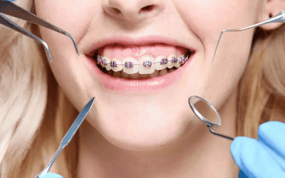 How Much Do Braces Cost In Toronto? Find Out Before You Start