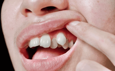 How To Fix A Snaggle Tooth – Causes & Treatment Options