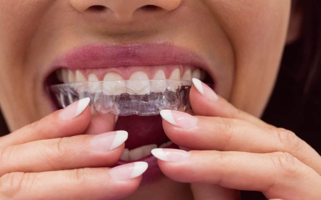 Invisalign cost Toronto