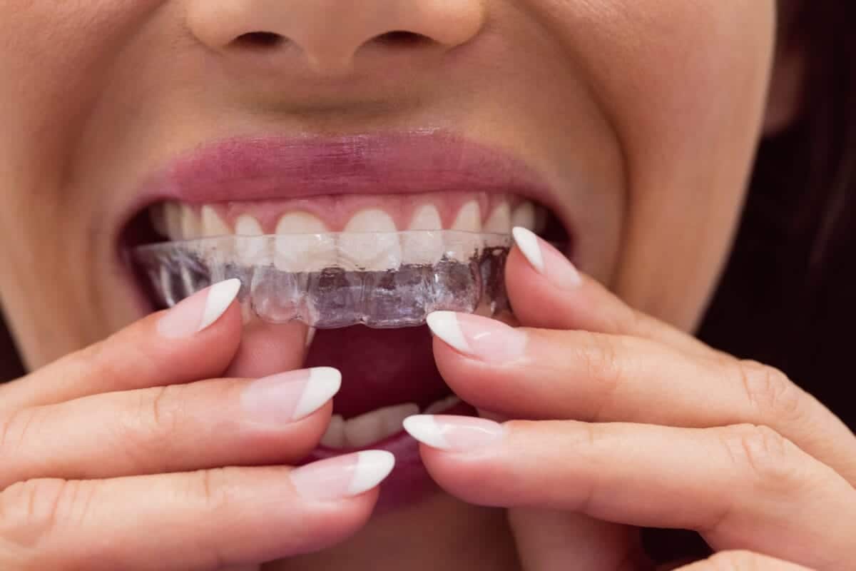 Invisalign cost Toronto