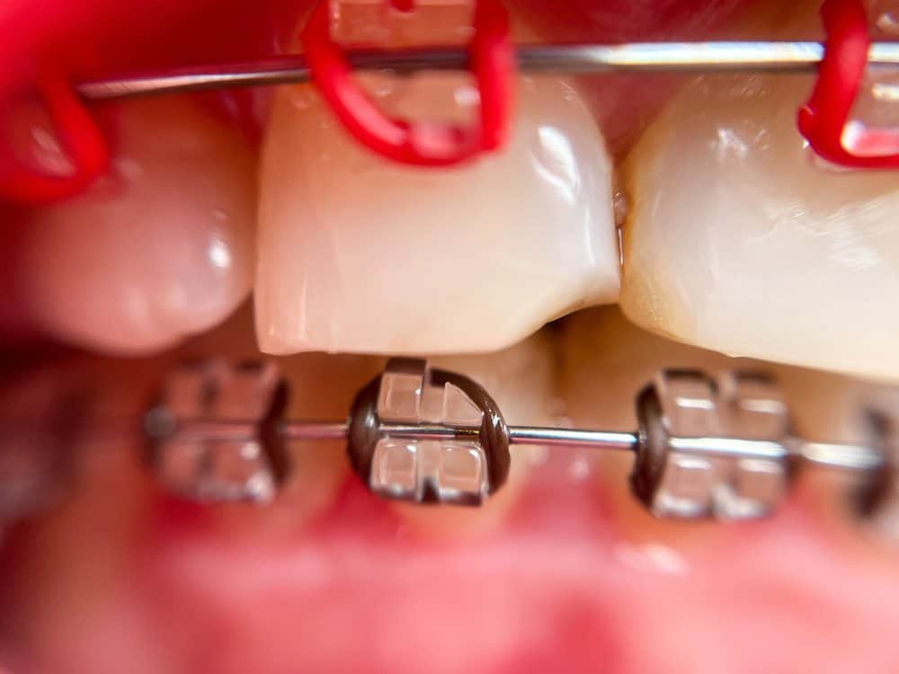 tooth pain emergency