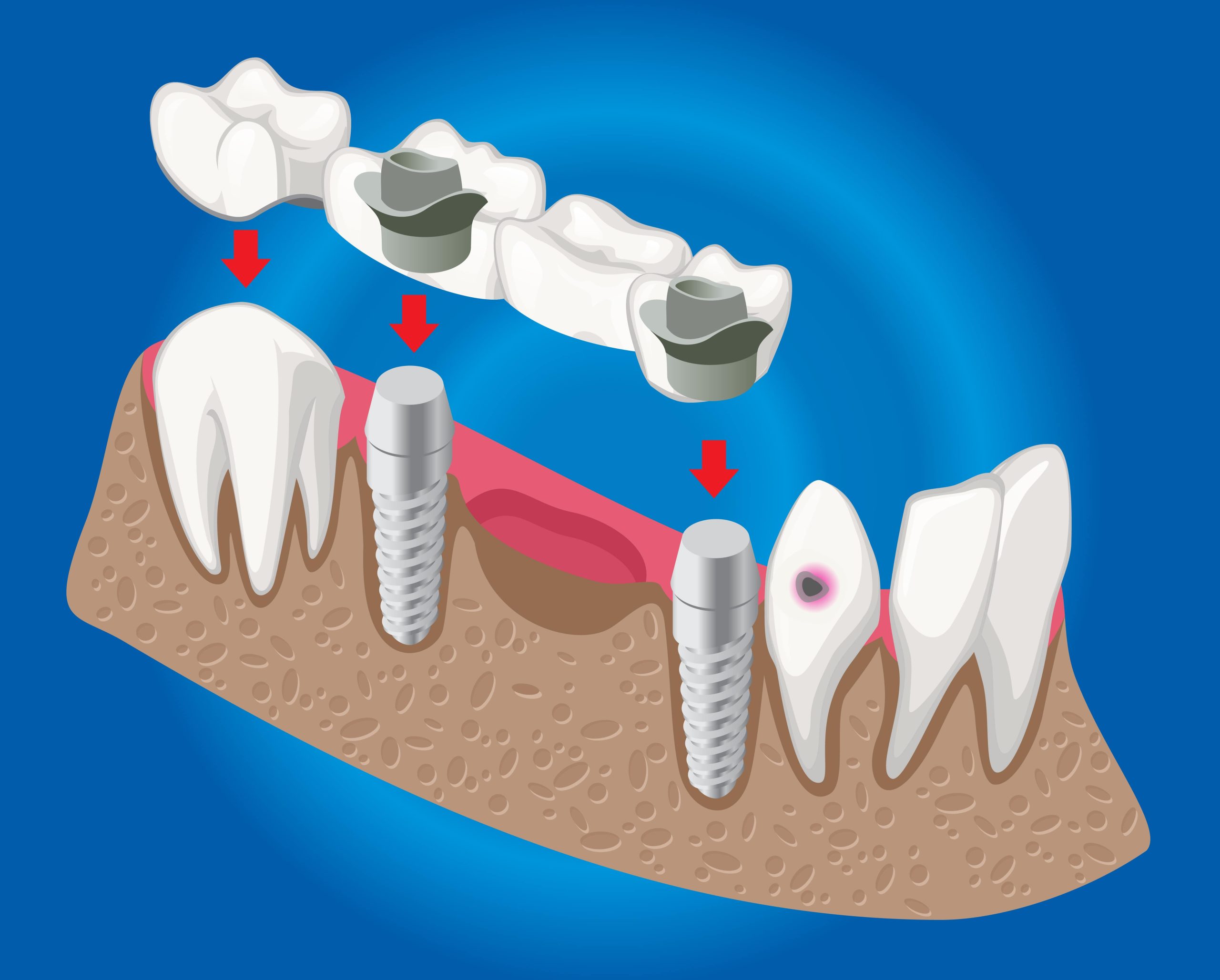 Dental Bridges vs Implants Dental Bridges vs Implants