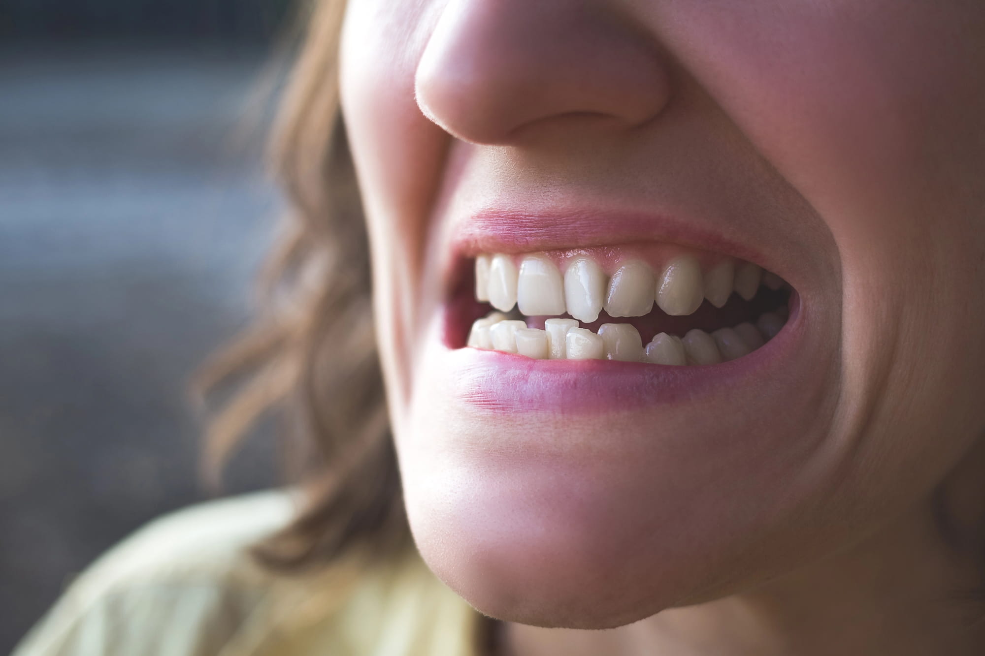 Invisalign vs Braces vs Veneers Which is Best for Crooked Teeth