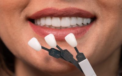 Do Veneers Ruin Your Natural Teeth? Truth vs Myth