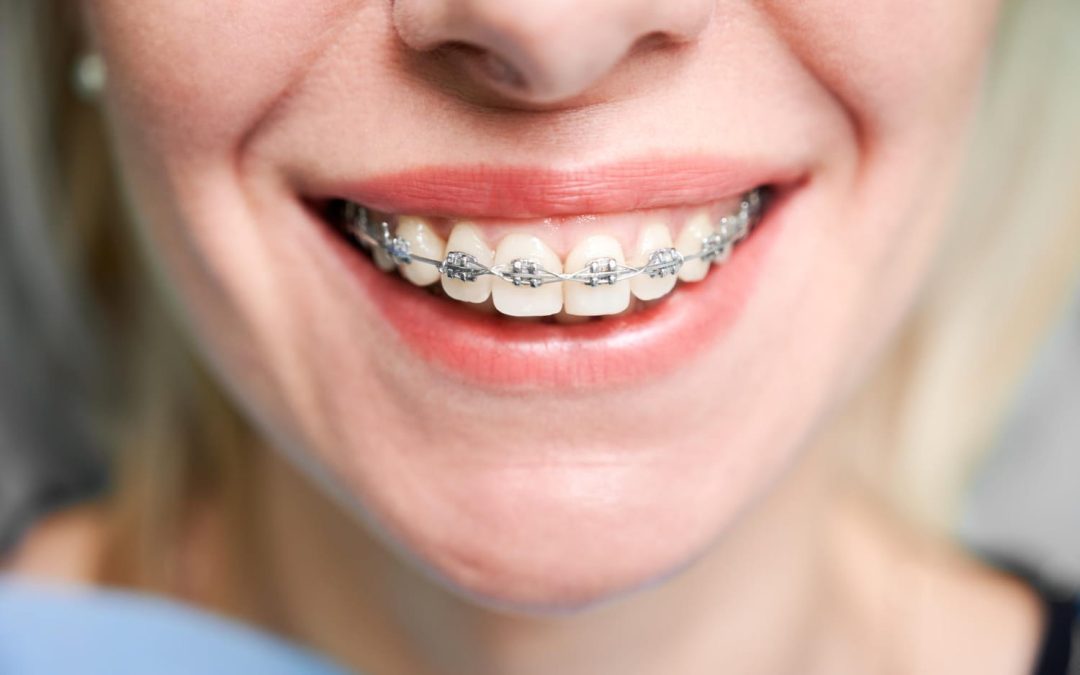 what are braces and how do they work
